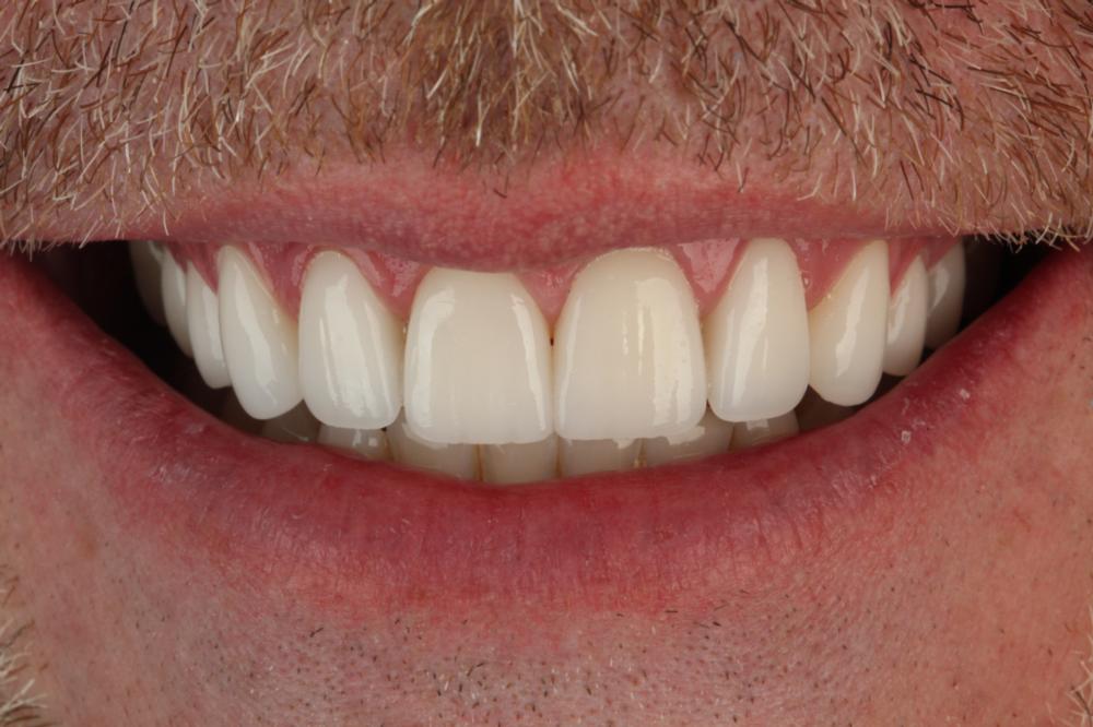 De Pere WI Dentist An Inside Look At Dr. Chads Smile Makeover!