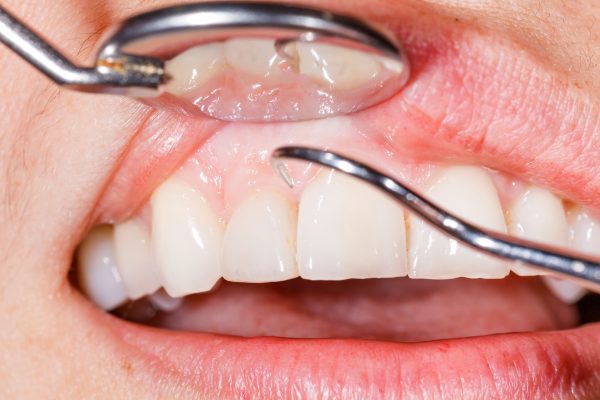 teeth and gums receiving examination with dental tools