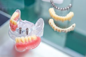 denture supported by mini implants on model