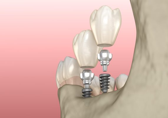 3d render of mini dental implants