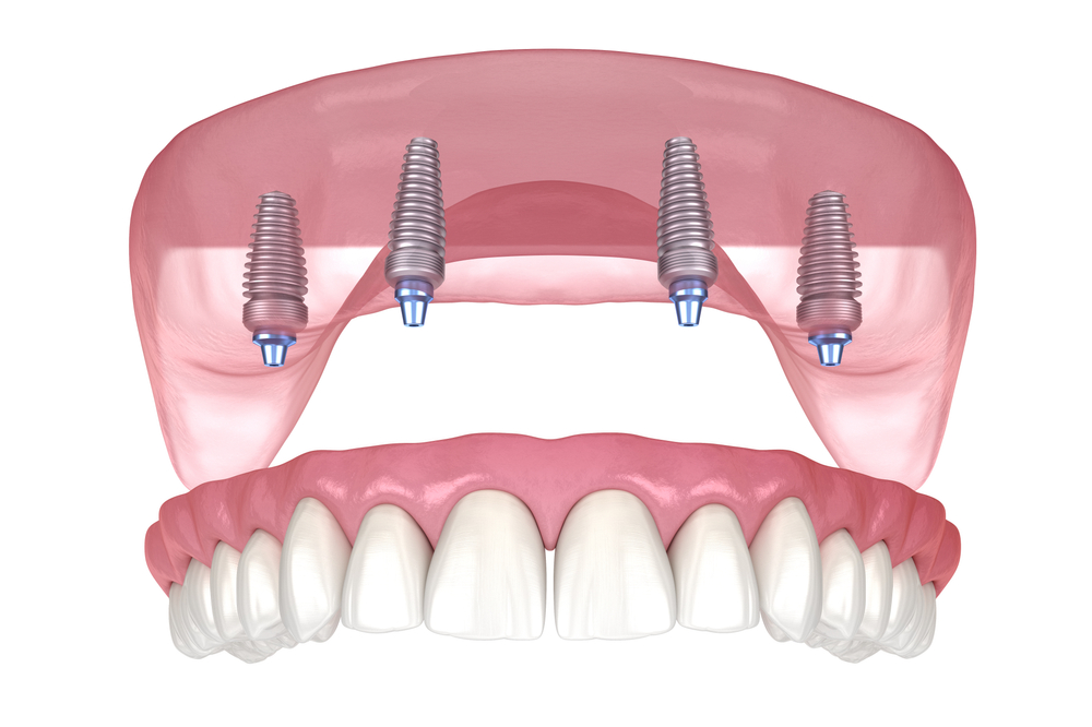 all-on-4 dental implants