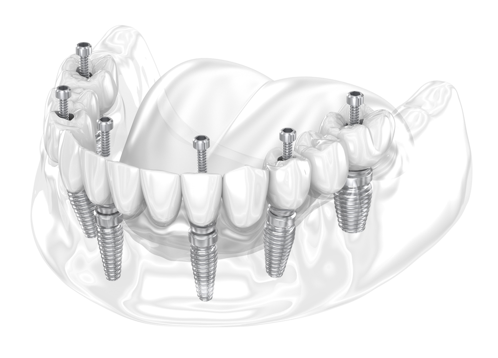 all-on-6 dental implants