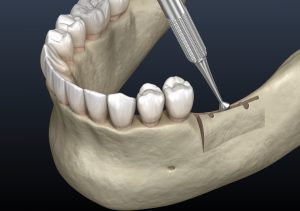 3d render of ridge augmentation