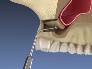 3d render of sinus lift