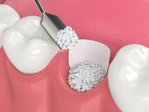 3d render of bone grafting procedure