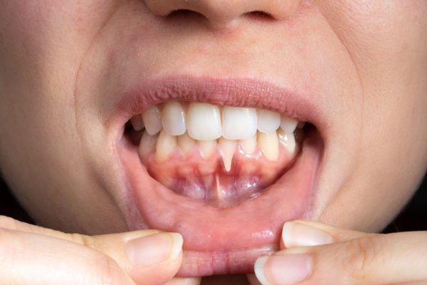 patient with gum recession