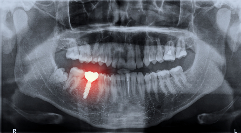 dental implant emergency x-ray