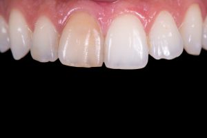 discolored teeth