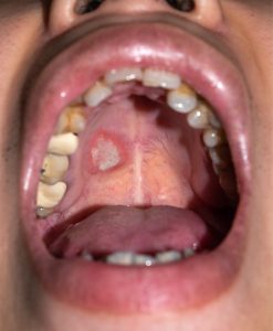 persistent ulcers