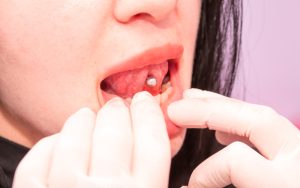 tongue piercing, oral piercing and teeth