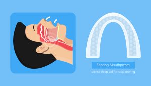 mouthpiece for sleep apnea