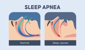 sleep apnea