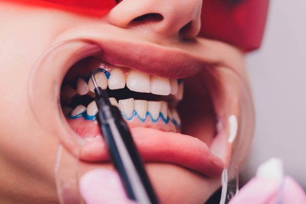 teeth whitening process in-office