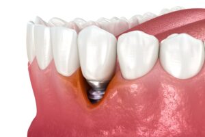 peri-implantitis
